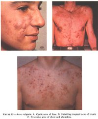Different types of Acne Vulgaris: A: Cystic acne on the face, B: Subsiding tropical acne of trunk, C: Extensive acne on chest and shoulders.
