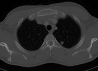 ACC metastasis in lung