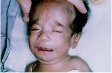 A newborn baby with FAS. The photograph is from the clinic of Dr. Jon Aase, University of New Mexico. [2] 