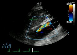 Echocardiogram of an aortic dissection