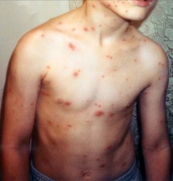 Child with varicella disease.