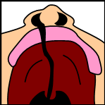 Unilateral complete lip and palate