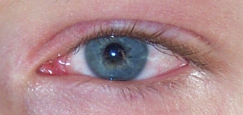 An eye with viral conjunctivitis