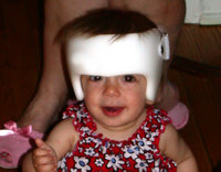 A child wearing a cranial band.