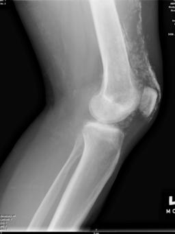 X-Ray of the knee in a patient with dermatomyositis.
