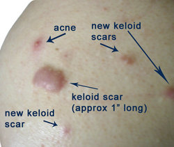 A person's shoulder displaying keloid scars and acne
