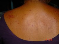 Petichial spots over the back