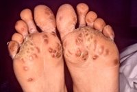 'A differential diagnosis revealed that the rash on the bottom of this individualâ€™s feet, known as keratoderma blennorrhagica, was due to Reiter's syndrome, not a syphilitic infection as was initially suspected' - CDC/ Dr. M. F. Rein 
