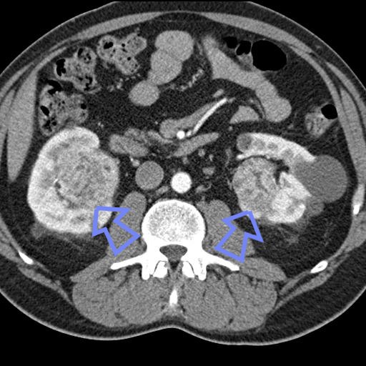 A CT scan showing bilateral renal cell carcinomas