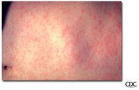 How Measles affects the skin.