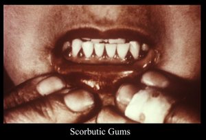 Scurvy may cause gingival inflammation and hemorrhaging, a condition termed scorbutic gums.