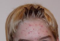 Acne of a 14 year old boy during puberty.