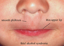 A thin upper lip and a smooth philtrum are signs of FAS