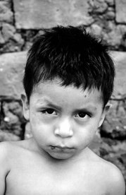 This child from Panama is suffering from Chagas disease manifested as an acute infection with swelling of the right eye (RomaÃ±a's sign). Source: CDC.
