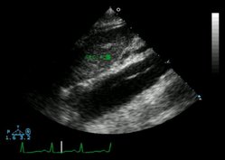 Echocardiogram of an aortic dissection