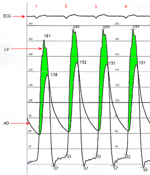 Simultaneous left ventricular and aortic pressure tracings demonstrate a pressure gradient between the left ventricle and aorta, suggesting aortic stenosis. The left ventricle generates higher pressures than what is transmitted to the aorta.  The pressure gradient, caused by aortic stenosis, is represented by the green shaded area. (AO = ascending aorta; LV = left ventricle; ECG = electrocardiogram.)