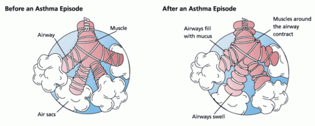 During an asthma episode, inflamed airways react to environmental triggers such as smoke, dust, or pollen. The airways narrow and produce excess mucus, making it difficult to breathe.