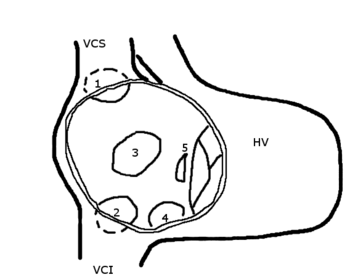 Schemating drawing showing the location of different types of ASD, the view is into an opened right atrium. HV: right ventricle; VCS: superior caval vein; VCI: inferior caval vein; 1: upper sinus venosus defect; 2: lower sinus venosus defect; 3: secundum defect; 4: defect involving coronary sinus; 5; primum defect.