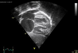 Ultrasound picture of the heart, seen in a subcostal view. The apex towards the right, atria to the left. ASD secundum seen as a discuntinuation of the white band of the atrial septum. Enlarged right atrium below, enlarged pulmonary veins seen entering left atrium above. (Echocardiogram: Wikipedia editor Kjetil Lenes (Ekko) )