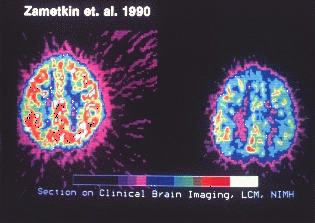 The image on the left illustrates areas of activity in the brain of a person without ADHD. The image on the right illustrates the areas of activity of the brain of someone with ADHD.  There is some controversy over the research by Dr. Alan Zametkin that produced these images. The children in these studies were in most cases severely dysfunctional.