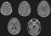 This is a set of images from an MRI of the brain in a patient with TSC.