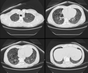 This computed tomography image shows randomly arranged cysts in both lungs.  The patient had TSC and a renal AML.