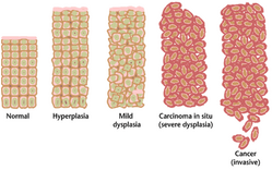 Tissue can be organized in a continuous spectrum from normal to cancer.