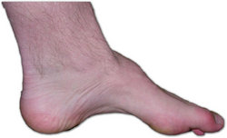 The foot of a person with Charcot-Marie-Tooth. The lack of muscle, high arch, and hammer toes are signs of the genetic disease.