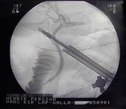 X-Ray during laparascopic cholecystectomy
