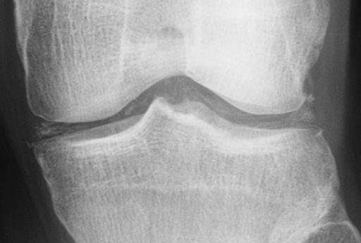 Chondocalcinosis of the articular and fibrocartilage of the left knee in a patient with calcium pyrophosphate dihydrate deposition disease (CPPD).