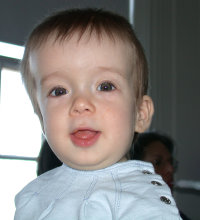 An image of a child with Lamdoid Cranial Synostosis. Notice the swelling on the right side of the head.