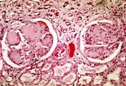 Photomicrography of nodular glomerulosclerosis in Kimmelstein-Wilson syndrome. Source: CDC