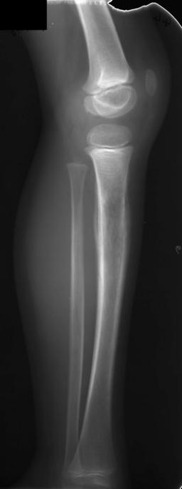 X-Ray of a child with Ewing's sarcoma of the tibia
