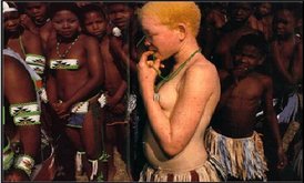 Young woman with albinism from Malawi. In some parts of Africa, albinism is considered a sign of bad luck, causing those with the genetic disorder to be shunned.