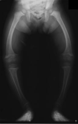 X-ray of the legs in a two-year-old child with rickets