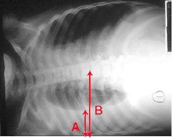 Pleural effusion Chest x-ray of a pleural effusion. The arrow A shows fluid layering in the right pleural cavity. The B arrow shows the width of the lung