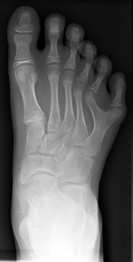 Right foot with postaxial polydactyly of 5th ray