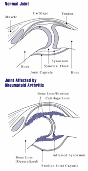 Joint abnormalities in rheumatoid arthritis