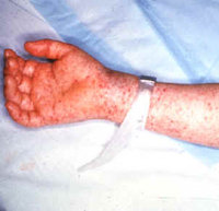 Petechial rash caused by rocky mountain spotted fever on the arm