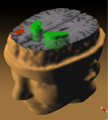 Data from a PET study25 suggests the less the frontal lobes activated (red) during a working memory task, the greater the increase in abnormal dopamine activity in the striatum (green), thought to be related to the neurocognitive deficits in schizophrenia.