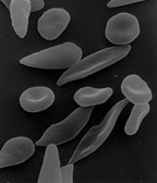 Sickle-shaped red blood cells