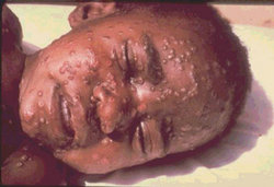 A smallpox victim.