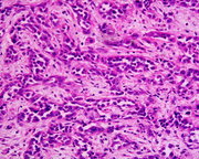 Low differentiated Adenocarcinoma of the stomach.