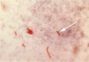 Acid-fast bacilli (AFB) (shown in red) are tubercle bacilli Mycobacterium tuberculosis.