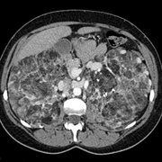This is an image from a contrast-enhanced CT of the abdomen in another patient with TSC.
