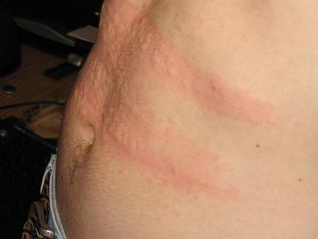 Irritation to the skin causes the mast cells to release histamine, resulting in the hives you see here.