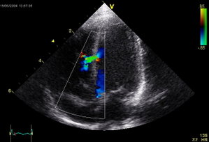 Echocardiographic image of a moderate ventricular septal defect in the mid-muscular part of the septum. The size and location is typical for a VSD in a new-born child.  The trace in the lower left shows the flow during one complete cardiac cycle and the red mark the time in the cardiac cycle that the image was captured. Colours are used to represent the velocity of the blood.  Flow is from the left ventricle (right on image) to the right ventricle (left on image).