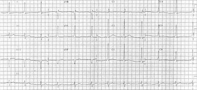 12 lead EKG of individual with Wolff-Parkinson-White syndrome.